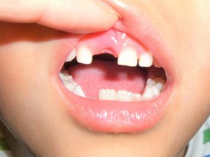 歯の生え変わり時期について ゆずる葉歯科
